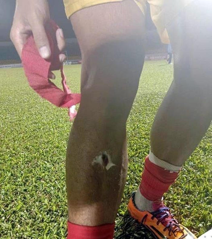 Sau va chạm khiến Hải Huy gãy chân, Hoàng Lâm lộ vết rách tới xương - 1