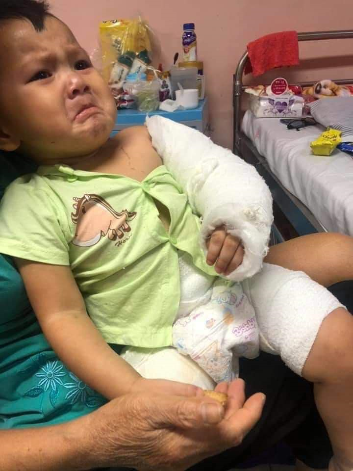 Xót thương bé gái bị cắt bỏ chân, gãy tay vì phút bất cẩn của người lớn - 2