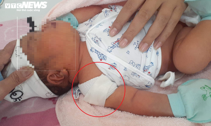 Thai lớn, bác sĩ vẫn cho sinh thường, em bé ra đời bị gãy xương đòn - 1