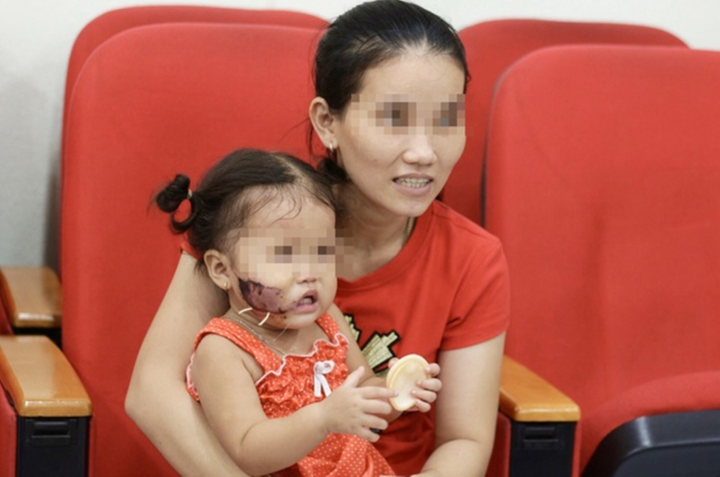 Ba trẻ nhỏ bị chó cắn nát mặt phải nhập viện - 1