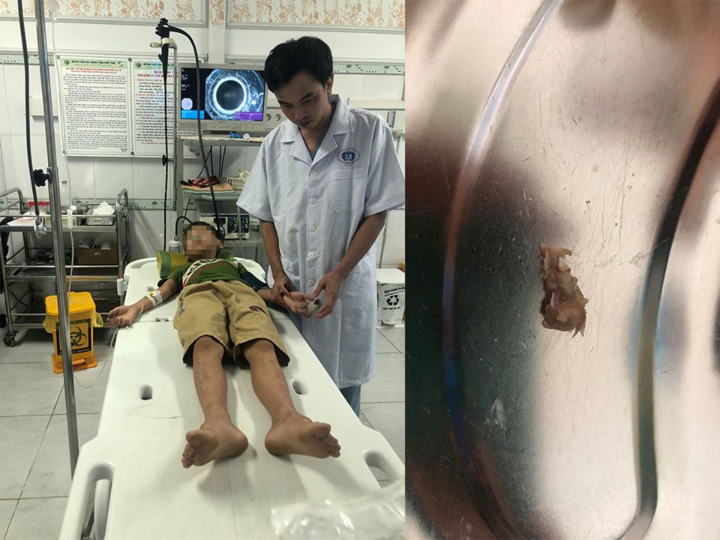 Hóc xương chim bồ câu, bé trai 9 tuổi suýt chết - 1