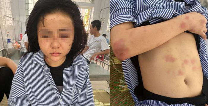 Khởi tố kẻ cuồng yêu đánh đập bạn gái suốt 2 tiếng - 1