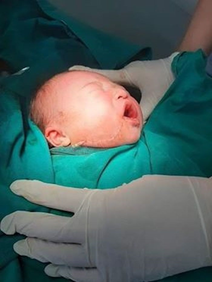 Đẻ tại nhà, bé vừa chào đời bị rách mặt do rơi vào dao cắt rốn - 1
