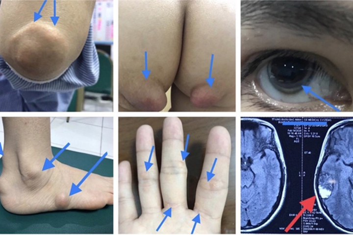 Mắc bệnh di truyền, một gia đình 28 người có thể chết trước tuổi 20 - 2