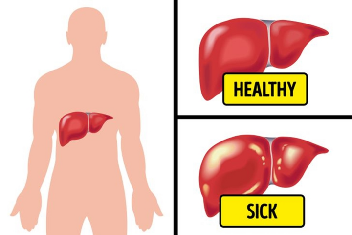 Đầy hơi kéo dài, có thể bạn đang đối mặt với các bệnh nguy hiểm sau - 2