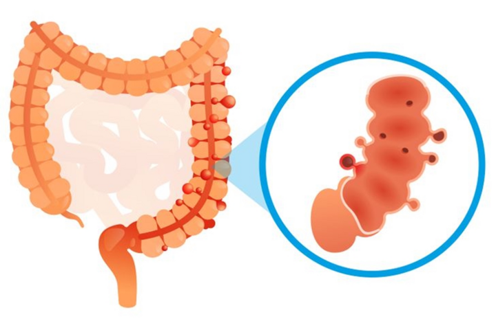 Đầy hơi kéo dài, có thể bạn đang đối mặt với các bệnh nguy hiểm sau - 4