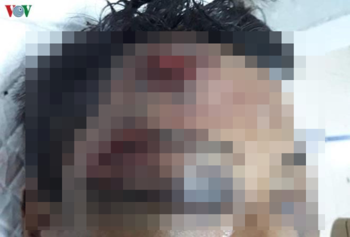 Rủ chủ nợ vào nhà uống rượu rồi trói, đánh nạn nhân nhập viện - 1