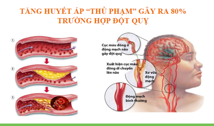 Tăng huyết áp ngày càng trẻ hóa, làm thế nào để điều trị và phòng ngừa? - 1