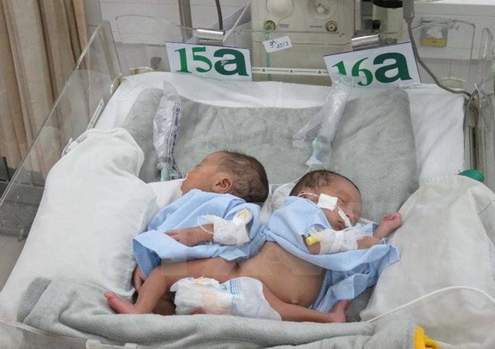 Những ca song sinh dính liền được phẫu thuật tách rời thành công tại Việt Nam - 3