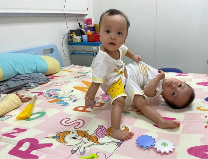 Những ca song sinh dính liền được phẫu thuật tách rời thành công tại Việt Nam - 4