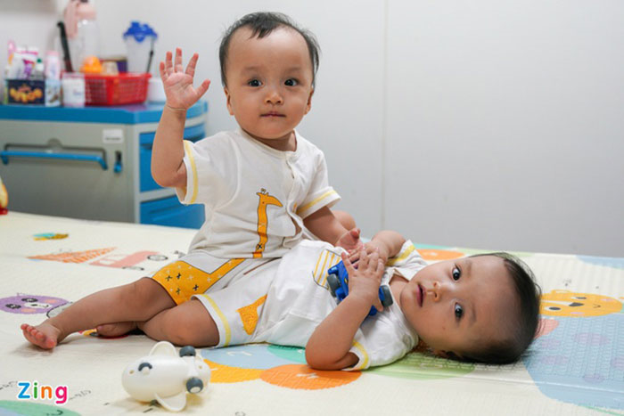 'Quyết định tách hai bé gái song sinh dính liền táo bạo nhưng nhân văn' - 2