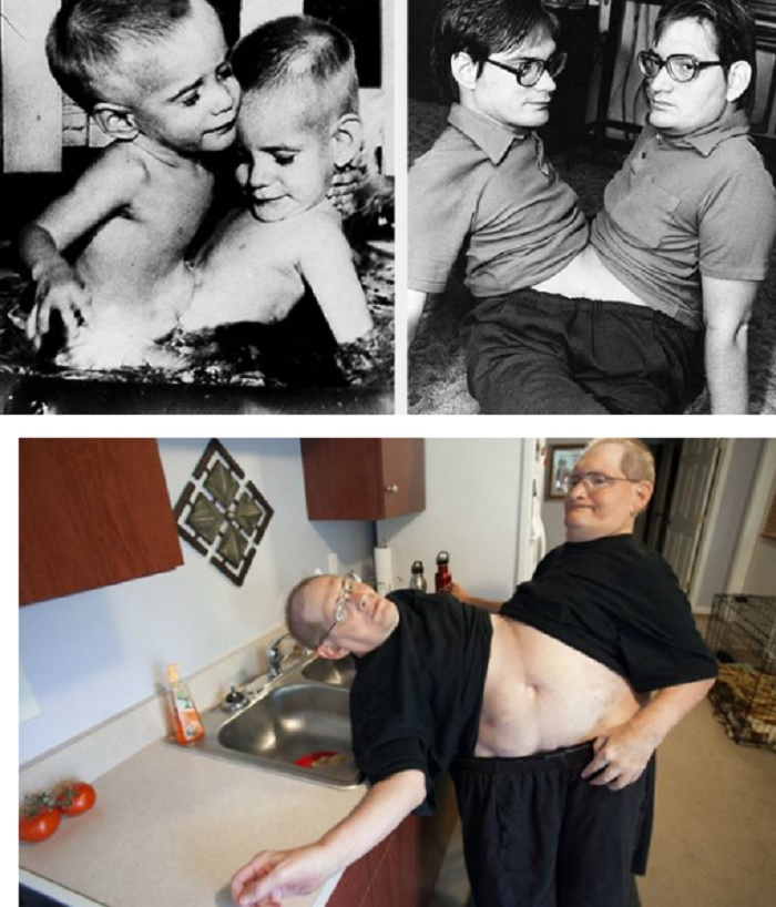 Kỳ lạ những cặp song sinh dính liền sống rất lâu dù không mổ tách - 3