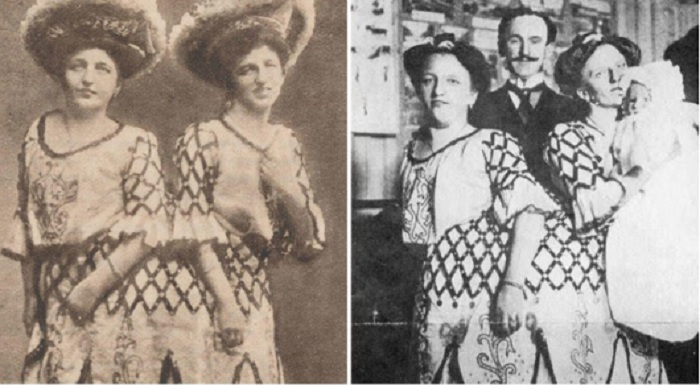 Kỳ lạ những cặp song sinh dính liền sống rất lâu dù không mổ tách - 4