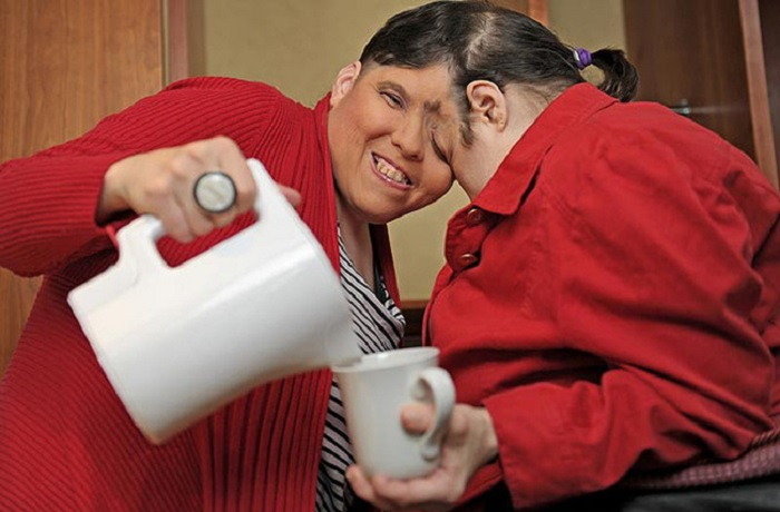 Kỳ lạ những cặp song sinh dính liền sống rất lâu dù không mổ tách - 5