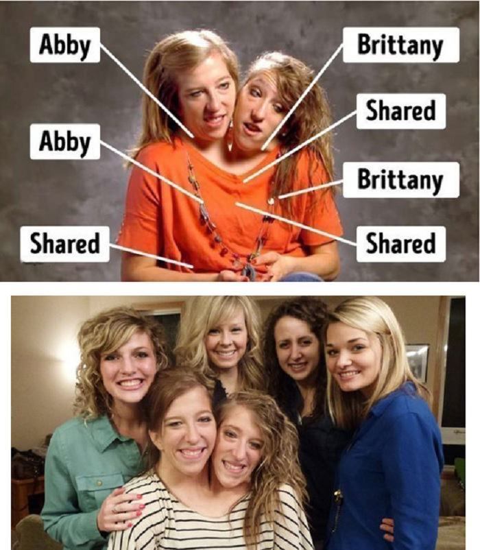 Kỳ lạ những cặp song sinh dính liền sống rất lâu dù không mổ tách - 6