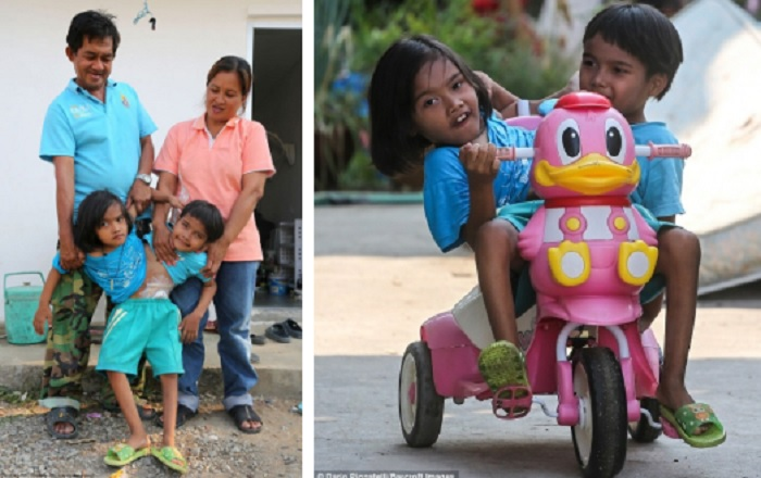 Kỳ lạ những cặp song sinh dính liền sống rất lâu dù không mổ tách - 7