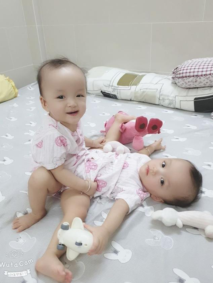 13 tháng dính nhau và 13 tiếng kỳ diệu tách rời cặp song sinh Trúc Nhi-Diệu Nhi - 1