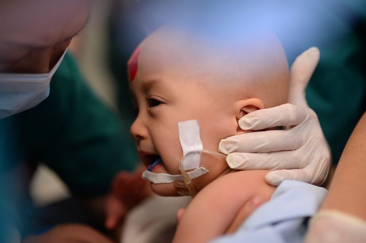 13 tháng dính nhau và 13 tiếng kỳ diệu tách rời cặp song sinh Trúc Nhi-Diệu Nhi - 2