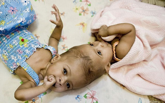 Ca phẫu thuật tách cặp song sinh dính liền đầu diễn ra thế nào? - 1