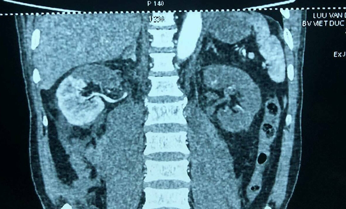 Lấy thận ra khỏi cơ thể để rửa rồi ghép lại cho bệnh nhân - 1
