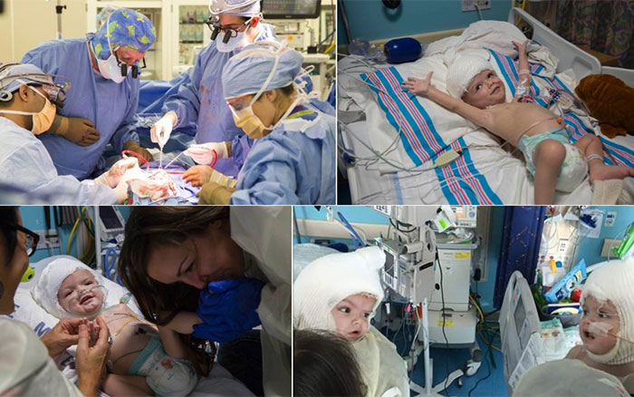 Sau phẫu thuật tách rời, cặp song sinh liền đầu ở Mỹ giờ ra sao? - 2