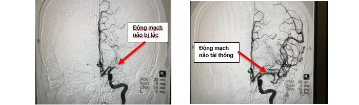 Vượt 150km đường biển và đường bộ kịp 'giờ vàng' cấp cứu bệnh nhân đột quỵ - 1