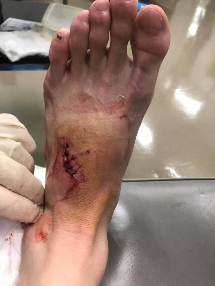 Hậu vệ Thái Lan khâu 8 mũi ở bàn chân vẫn tập tễnh ra sân thi đấu - 1