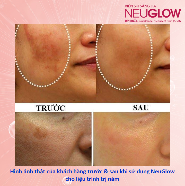 Anh Bo Đan Trường 'hack' tuổi với viên sủi trắng da Neuglow thương hiệu Anh Quốc - 4