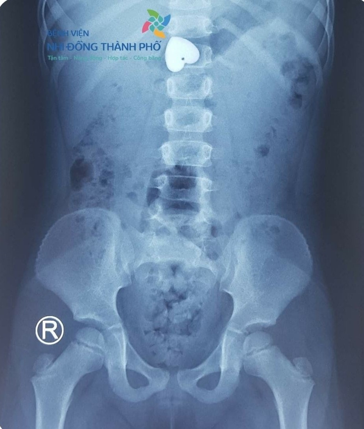 Cầm mặt dây chuyền hình trái tim chơi, bé gái 4 tuổi nuốt luôn vào bụng - 1