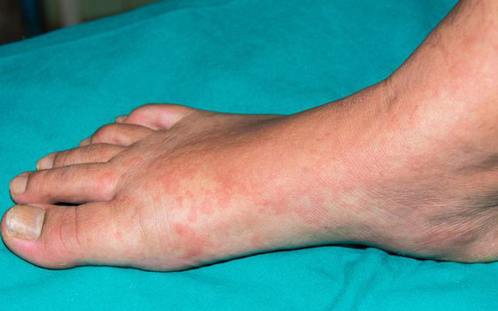 Phát ban ở chân có thể là dấu hiệu cảnh báo cơn đau tim - 1