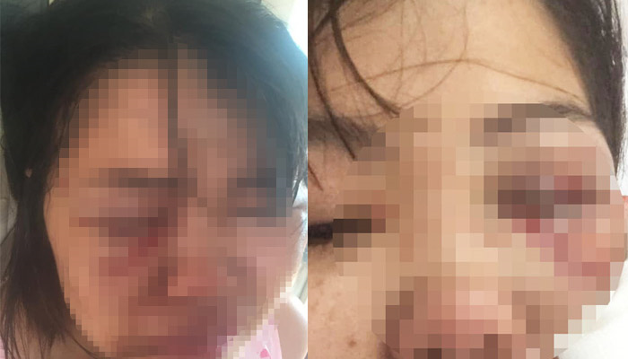 Đòi chia tay, vợ bị chồng đánh thâm tím mặt - 1