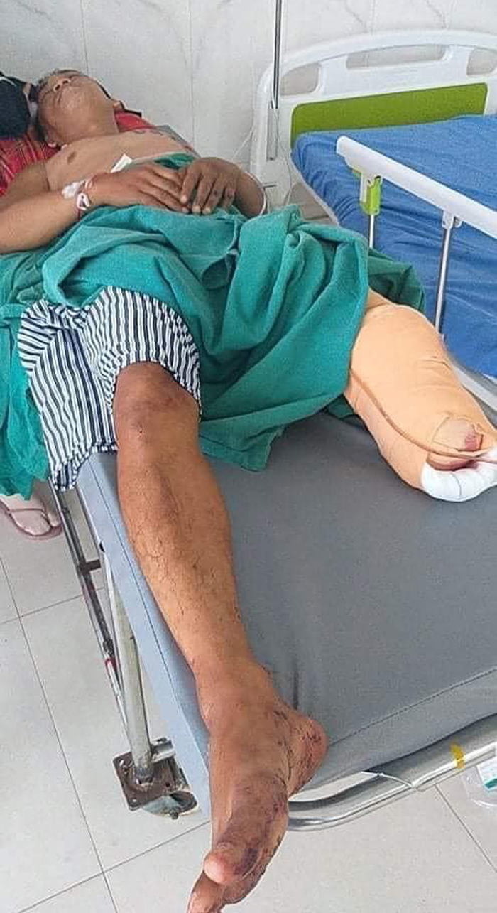 Máy cày gây tai nạn thảm khốc, cựu đội trưởng Đắk Lắk phải cưa chân - 1