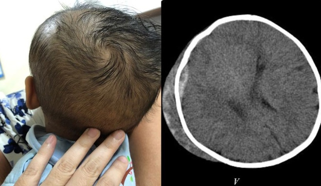 Ngã khi dùng xe tập đi, em bé 6 tháng tuổi bị tụ máu não - 1