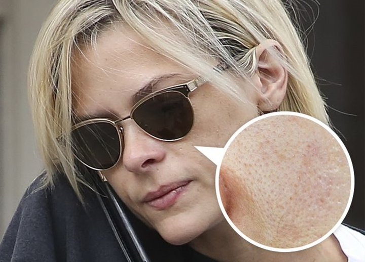 Thói quen xấu làm tắc nghẽn lỗ chân lông trên khuôn mặt - 2