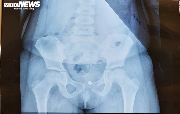 Gắp thành công viên bi mắc trong vùng kín bé gái 5 tuổi - 1