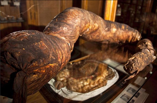 Người đàn ông chết khi cố đại tiện, ruột già được trưng bày trong bảo tàng Mỹ - 3