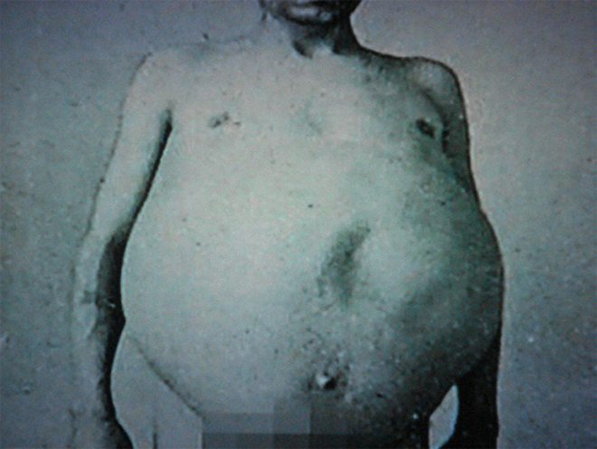 Người đàn ông chết khi cố đại tiện, ruột già được trưng bày trong bảo tàng Mỹ - 1