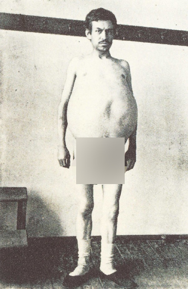 Người đàn ông chết khi cố đại tiện, ruột già được trưng bày trong bảo tàng Mỹ - 2