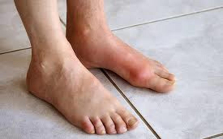 7 căn bệnh phổ biến liên quan đến béo phì - 7
