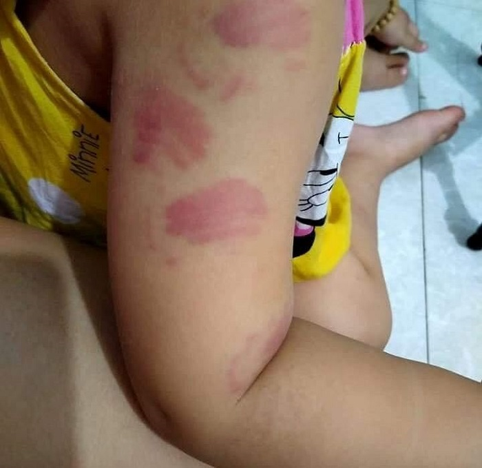 Bé 21 tháng tuổi ở Thái Bình bị bạn cắn tím người: Hiệu trưởng lên tiếng - 2