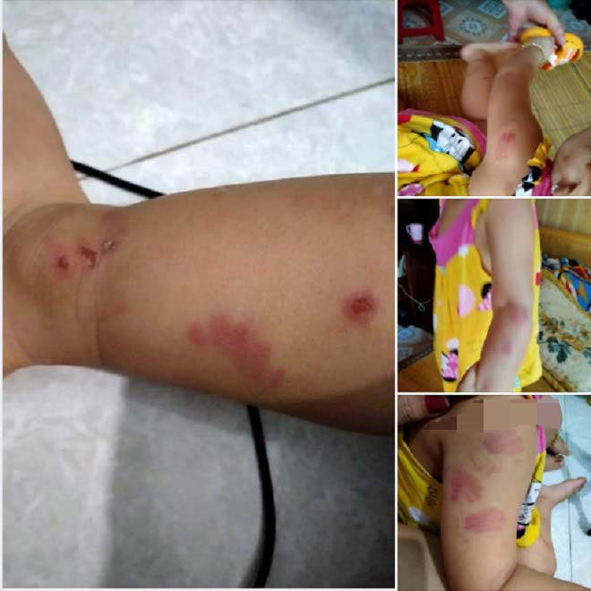 Bé 21 tháng tuổi bị bạn cắn tím người: Điều chuyển giáo viên phụ trách lớp - 1