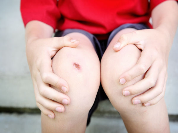 Những sai lầm khi sơ cứu mà nhiều người thường mắc phải - 1