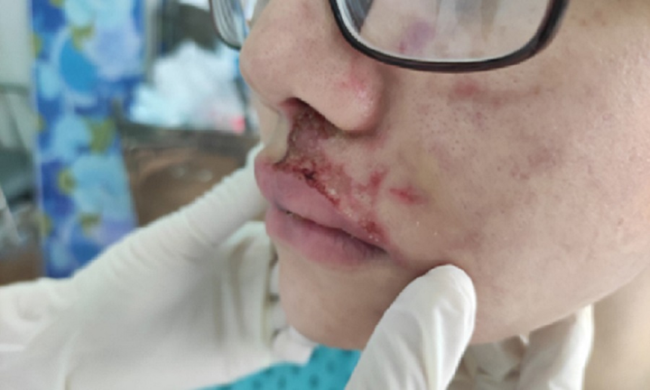 Ham rẻ tiêm filler giá 3,5 triệu đồng, mặt cô gái sưng phù, mưng mủ - 1