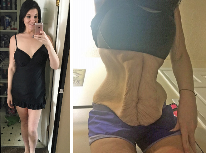 Vùng bụng nhăn nhúm của cô gái giảm 105kg trong 1 tháng khiến dân mạng khiếp sợ - 3