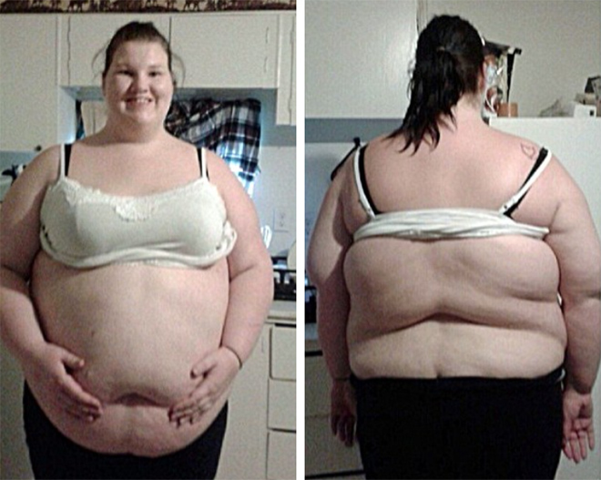 Vùng bụng nhăn nhúm của cô gái giảm 105kg trong 1 tháng khiến dân mạng khiếp sợ - 1