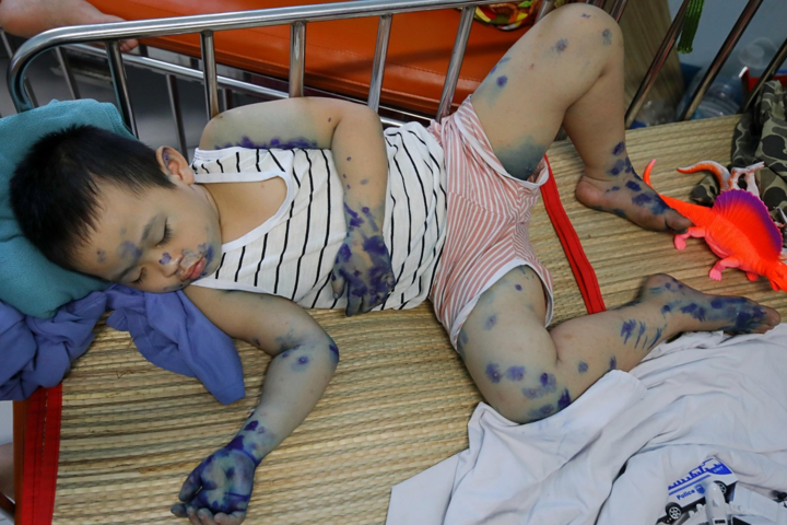 Ảnh: Bệnh chân tay miệng gia tăng nhanh ở TP.HCM - 8