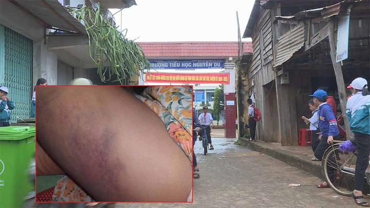 Đề xuất kỷ luật khiển trách cô giáo đánh học sinh lớp 3 bầm tím đùi - 1