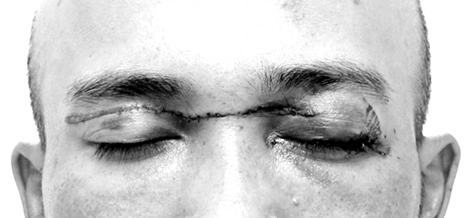 Đi xe máy vướng phải dây diều, người đàn ông gần đứt rời mi mắt, suýt mù - 1