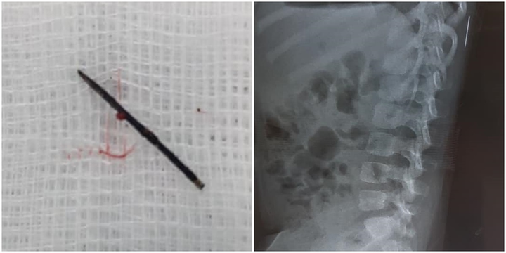 Phẫu thuật lấy kim khâu gỉ đen trong cơ thể bé 3 tuổi - 1