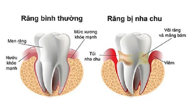 Uống nhiều nước nhưng vẫn khô miệng: Cẩn thận mắc bệnh nguy hiểm - 2